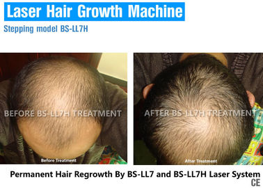 De hoge Lichte Therapie van de Beëindigenlaser voor Haarverlies, de Laserbehandeling van de Haargroei