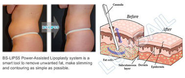 300W chirurgische Liposuction-Machine voor Hogere/Lagere Achterliposuction