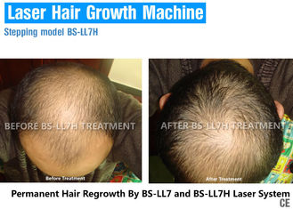 De verticale Therapie van de Laag Lichtlaser voor Haarverlies, Laserbehandeling voor Kaalheid