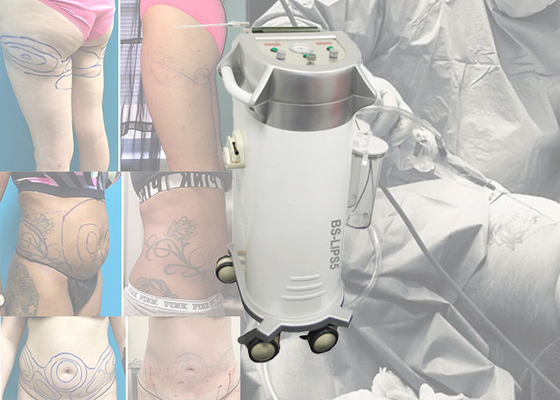 De Chirurgische Liposuction Machine van plastische chirurgieabdominoplasty voor Buikplooi/de Chirurgie van Maagliposuction