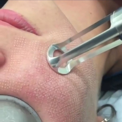 Draagbare 15w-van het de Acne Chirurgische Litteken van Co2 Verwaarloosbare de Lasermachine